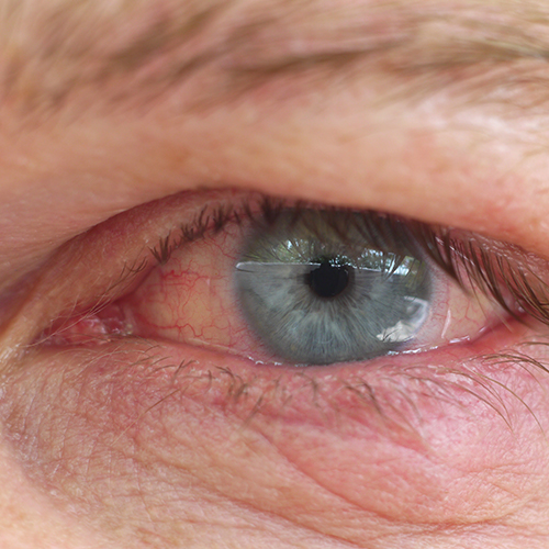 The latest information on dry eye disease