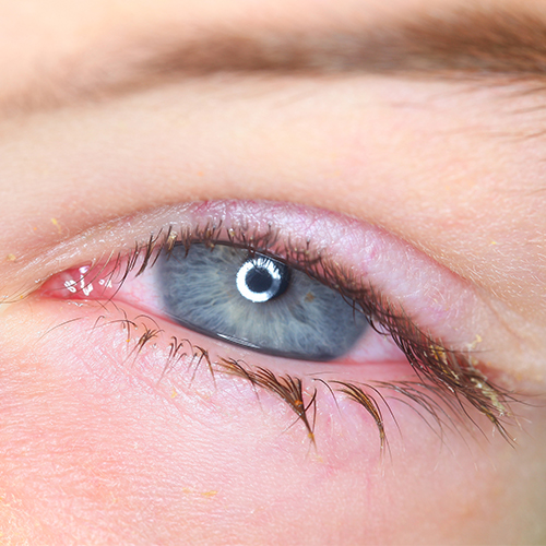 Why are some eye infections difficult to treat? What strategies can be adopted