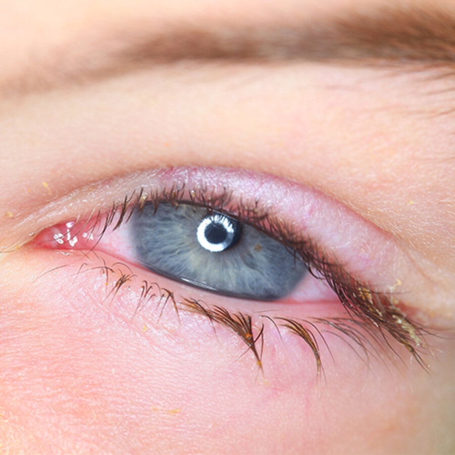 Cosa c’è di nuovo sulla malattia dell’occhio secco