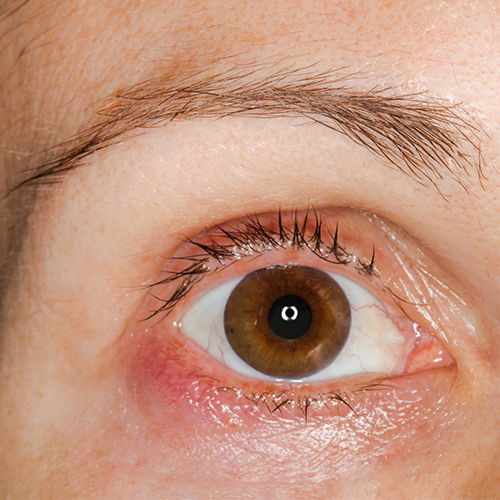 Why are some eye infections difficult to treat? What strategies can be adopted