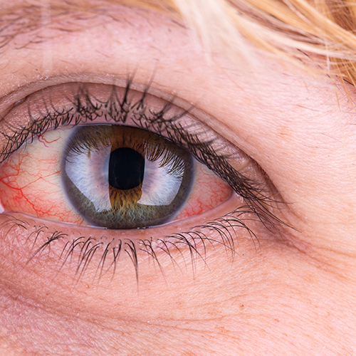 Do you find contact lenses uncomfortable? Find out why