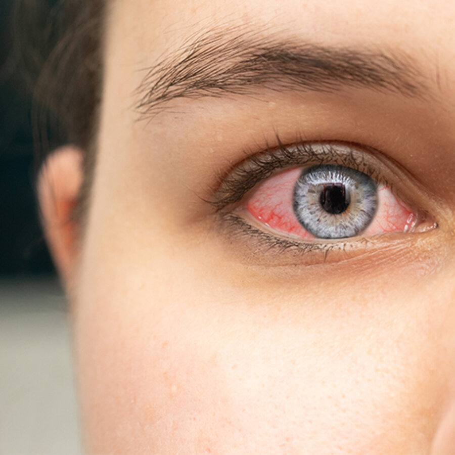 The microbiota in eye diseases