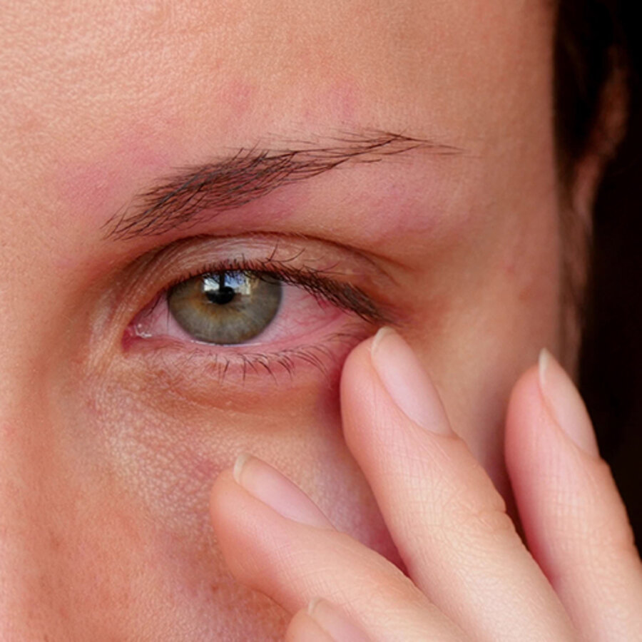 Why are some eye infections difficult to treat? What strategies can be adopted