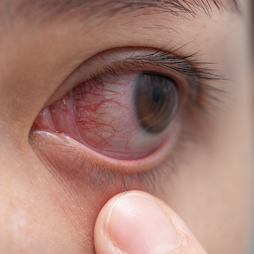 The microbiota in eye diseases